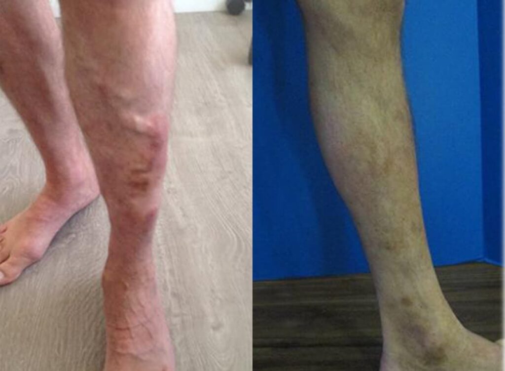 Before And After Spider Vein Removal
