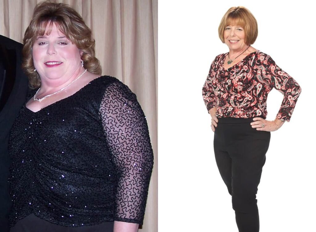 Before and After Bariatric Surgery