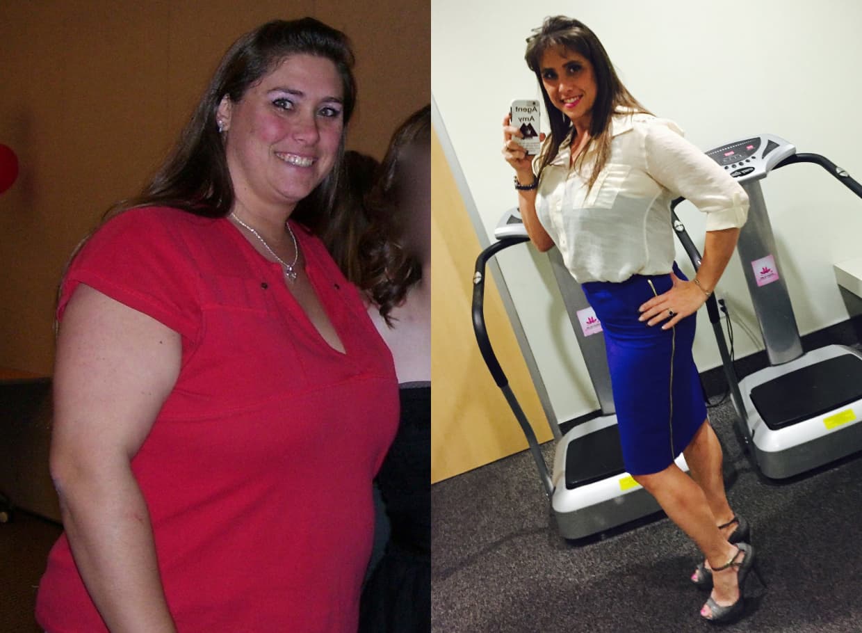 Before and After Bariatric Surgery: Real Patient Results