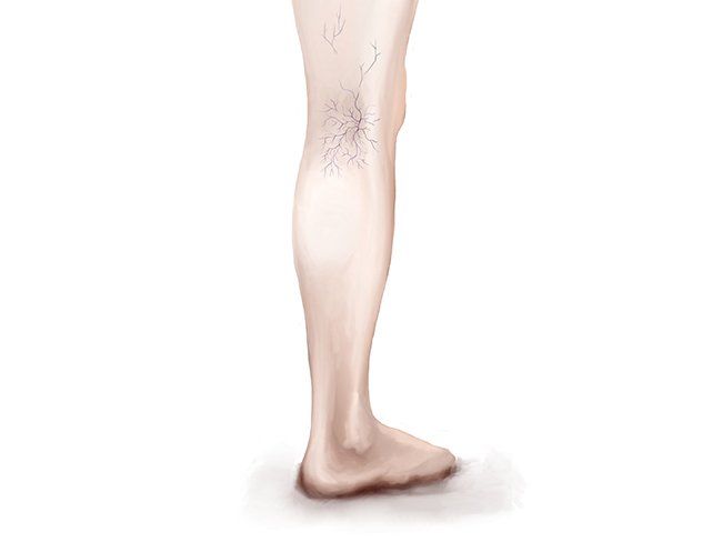 Chronic Venous Insufficiency Legs