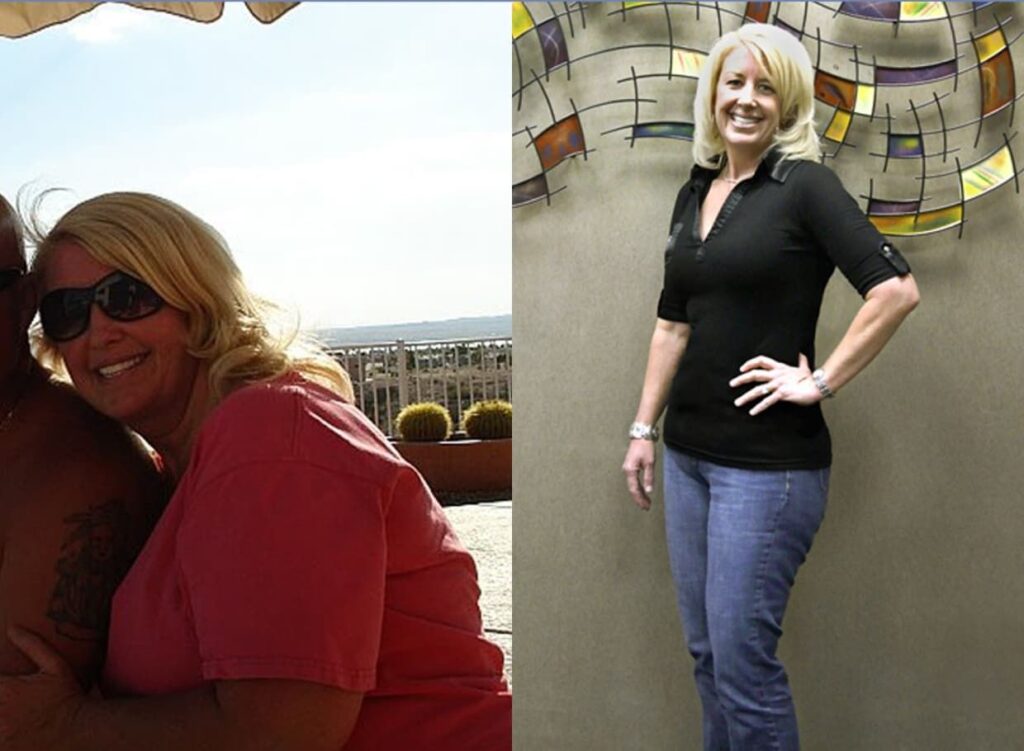 Weight Loss After Bariatric Surgery