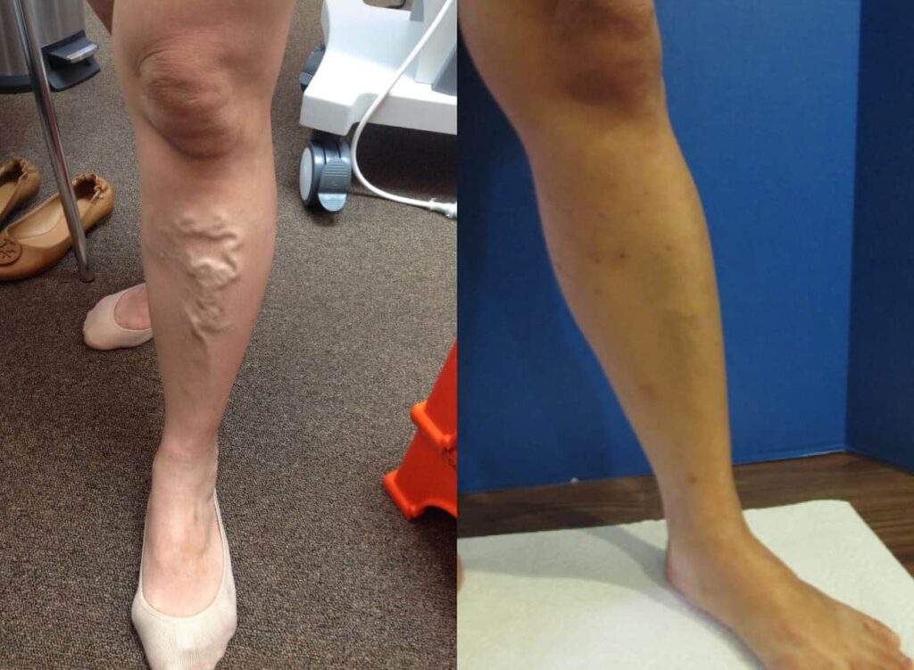 Varicose Vein Treatment Before And After