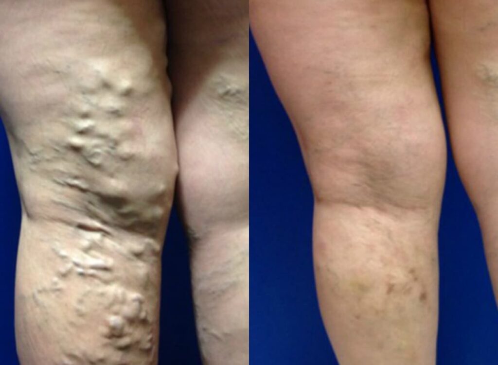Varicose Vein Treatment Before And After