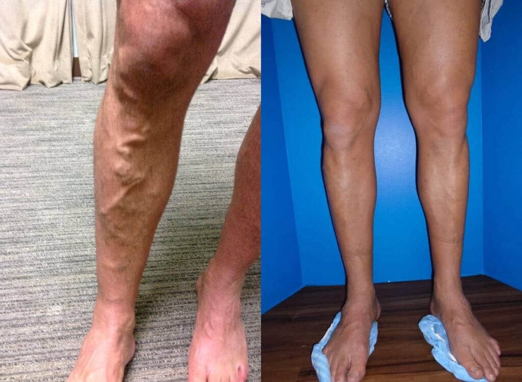 Before And After Spider Vein Removal