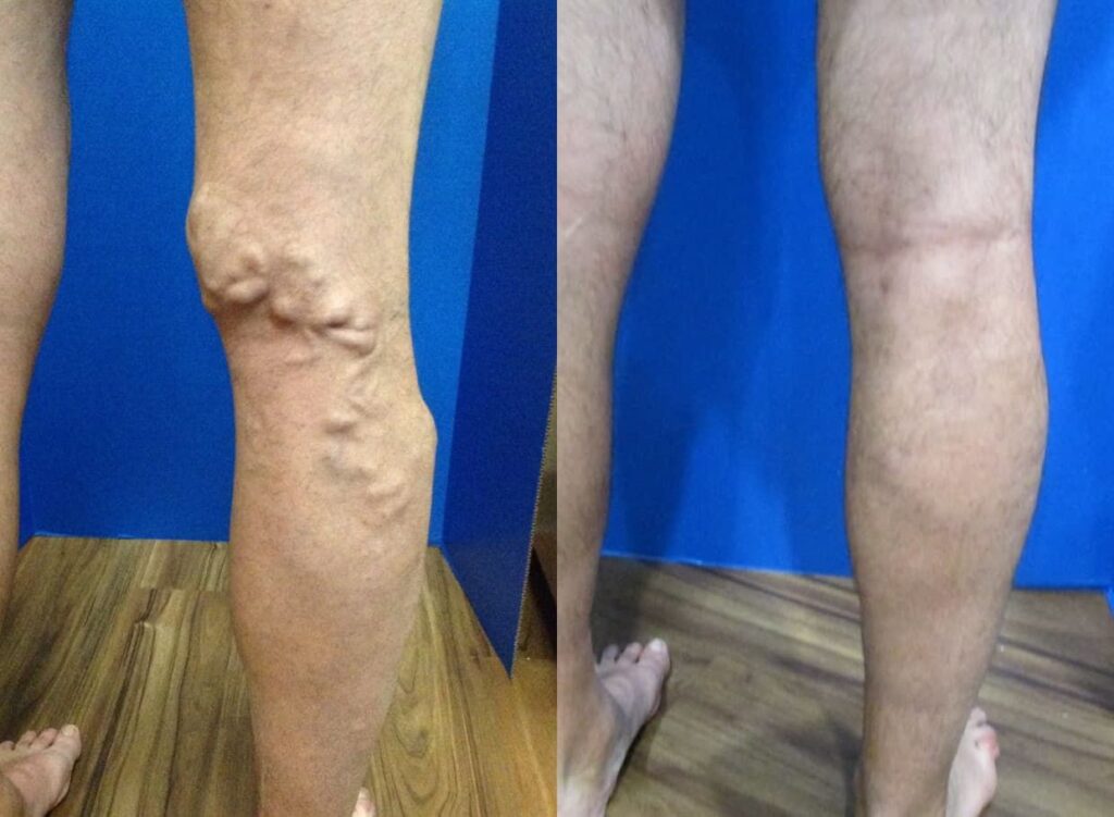 Vein Treatment Before And After