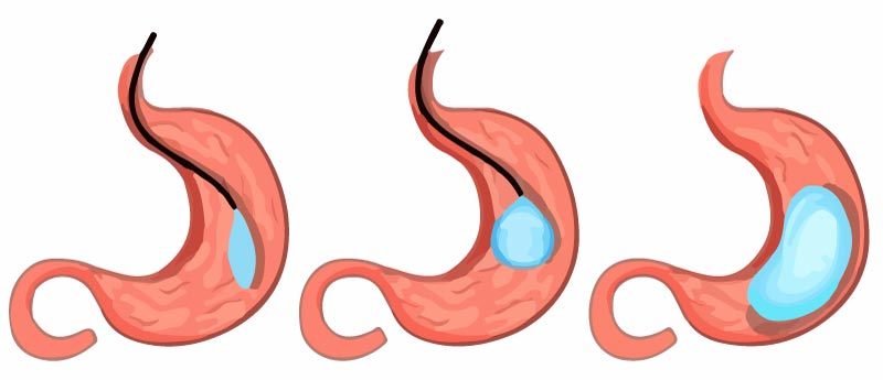 gastric balloon surgery - West Medical