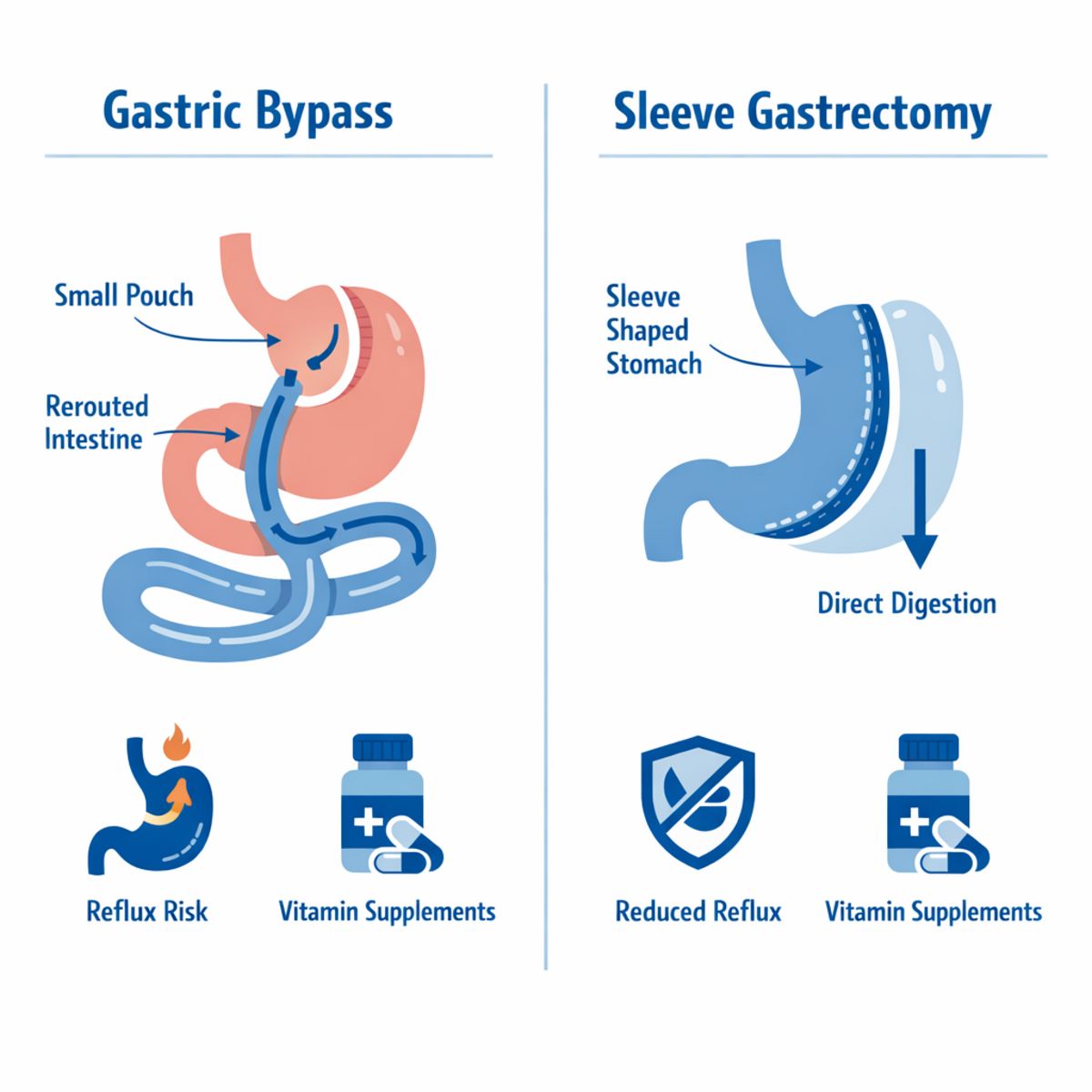 Infographic comparing gastric bypass and sleeve gastrectomy with anatomy, digestion, reflux, and supplementation icons.