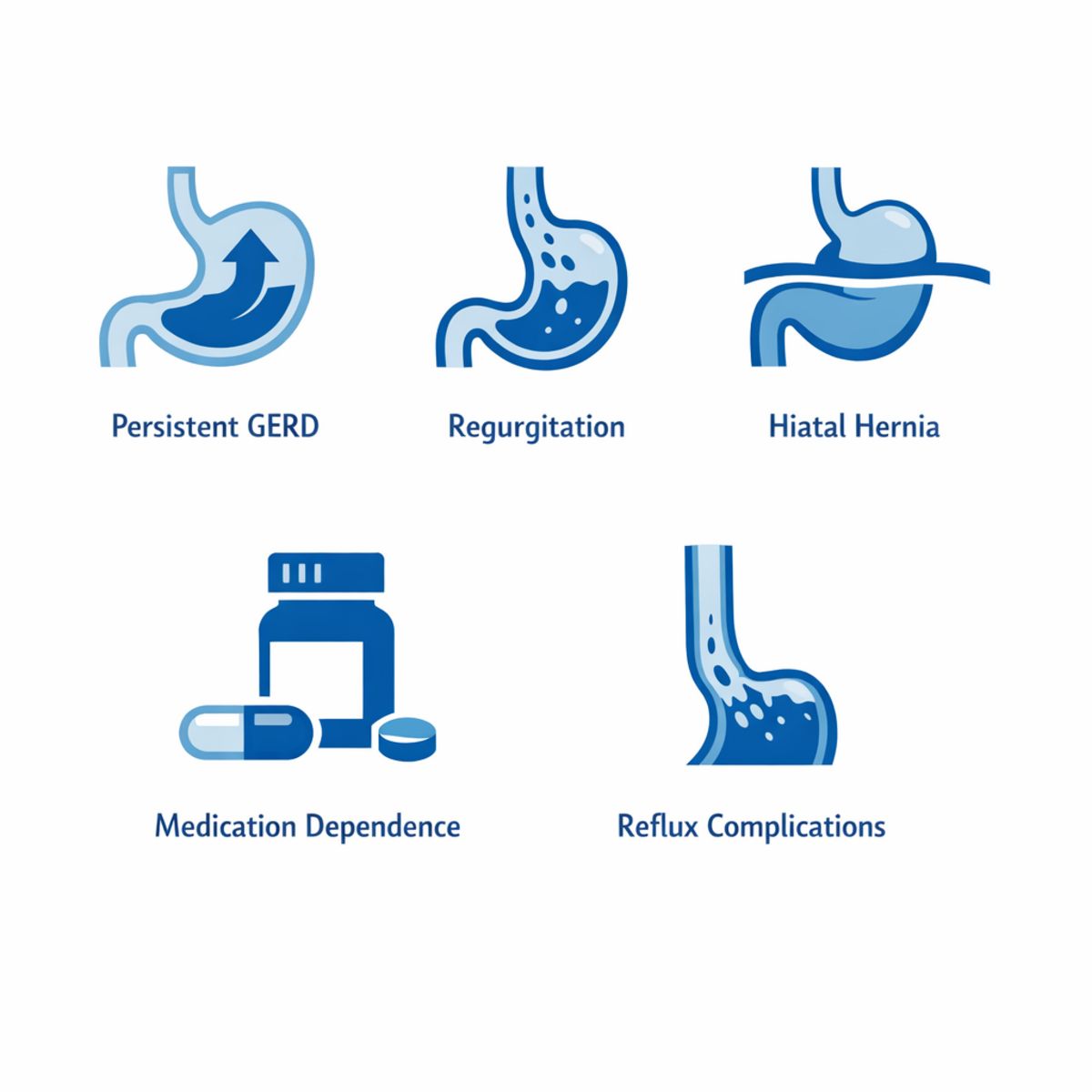 Infographic showing five icons for reasons surgery is considered in GERD cases.